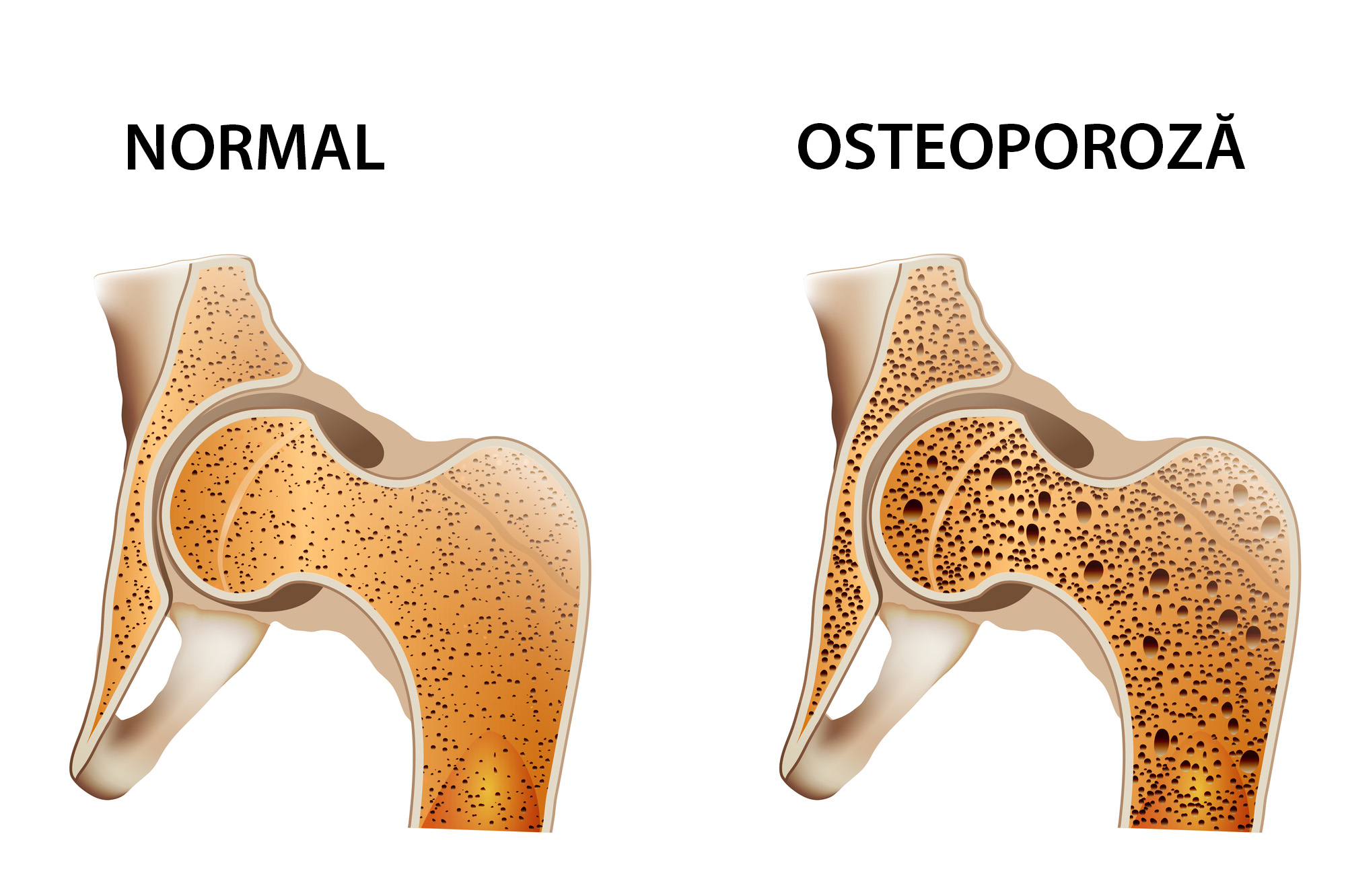 Osteoporoză - ilustrație medicală