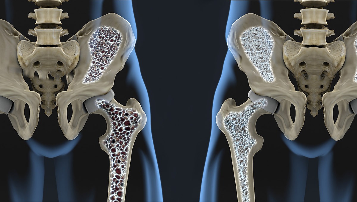 Osteoporoză comparație